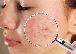 Image result for Severe Cystic Acne