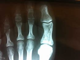 Image result for Broken Toe Bone