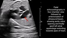 Image result for Right Atrial Appendage Fetal Echo