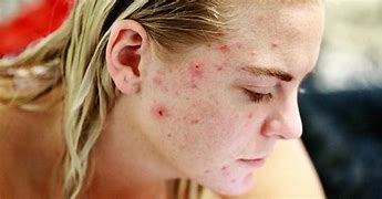 Image result for Pimple Breakout