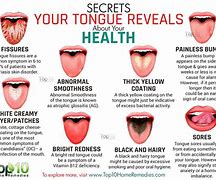 Image result for Cold Sore On Tongue