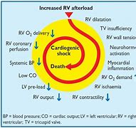 Image result for Pulmonary Embolism Post-Mortem Changes