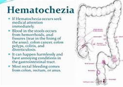 Image result for Hematochezia Ddx IBD