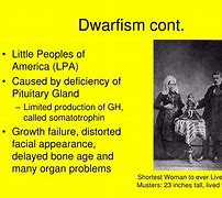 Image result for Gigantism Acromegaly and Dwarfism