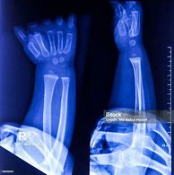 Image result for X-ray of Baby Hand