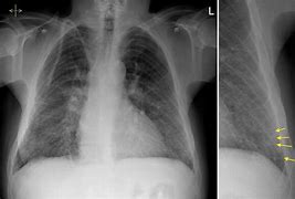 Image result for Acute Pulmonary Oedema and Fluid Overload