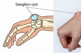 Image result for Ganglion Cyst in Capitate