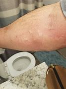 Image result for Histamine Reaction