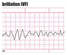 Image result for Ventricular Fibrillation EKG Examples