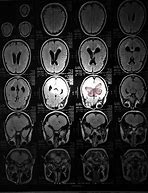 Image result for Neuropil Medulloblastoma