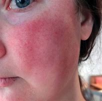 Image result for Fair Skin Red Cheeks