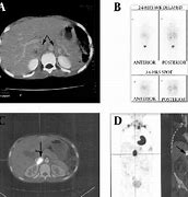 Image result for Pheochromocytoma On CT Scan