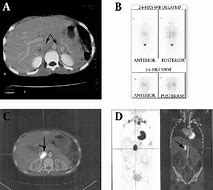 Image result for Pheochromocytoma CT Abdomen