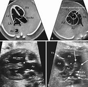 Image result for Abnormal Fetal Heart Ultrasound