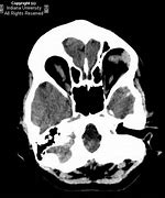 Image result for Achondroplasia X-ray