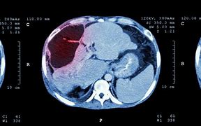 Image result for Hemangioma On Liver