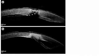 Image result for Corneal Perforation