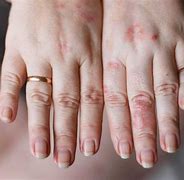 Image result for Soap Skin Rash