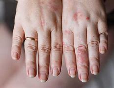 Image result for Rash Caused by Detergent