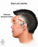 Image result for Giant Cell Temporal Arteritis