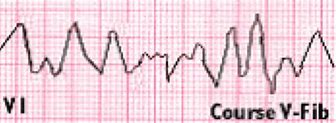 Image result for Course V-fib