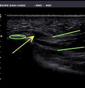 Image result for Plantar Fascia Steroid Injection