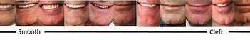 Image result for What Is Cleft Chin