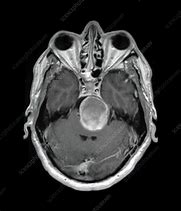 Image result for Aneurysm in MRI