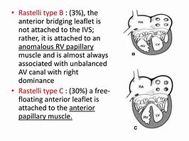 Image result for Atrioventricular Canal Defect Osmosis