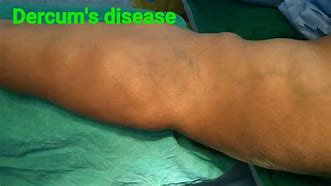 Image result for Dacunculiasis