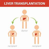 Image result for Liver Transplant Clip Art