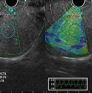 Image result for Biloma Ultrasound Images Post-Cholecystectomy