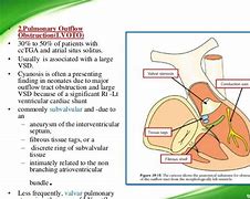 Image result for Right Ventricular Outflow Tract