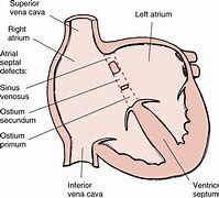 Image result for Septum Secundum