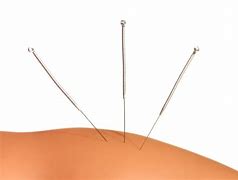 Image result for Acupuncture