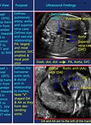 Image result for Abnormal Fetal Heart Ultrasound