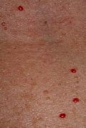 Image result for Dark Red Spots On Skin