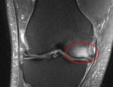 Image result for Heel Cord Tenotomy