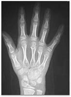 Image result for Normal Hand Radiograph