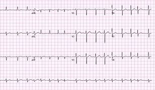 Image result for Atrial Fibrillation 12 Lead ECG