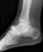 Image result for Charcot Bone Disease