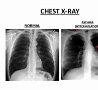 Image result for Asthma Chest X-Ray