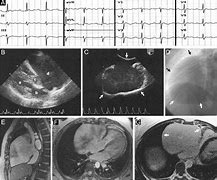 Image result for Right Atrial Appendage Aneurysm