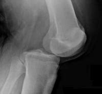 Image result for What Does a Dislocated Pinky Look Like