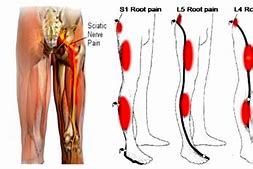 Image result for L3 L4 Sciatica