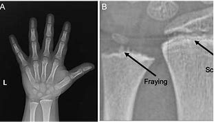 Image result for Bone Age Hand X-ray