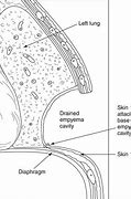 Image result for Pathophysiology of Empyema