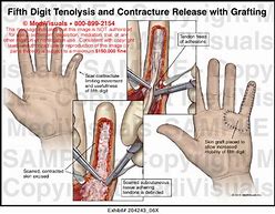 Image result for Fifth Digit Finger