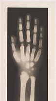 Image result for Normal Hand Radiograph