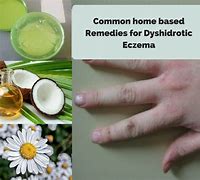 Image result for Best Treatment for Dyshidrotic Eczema